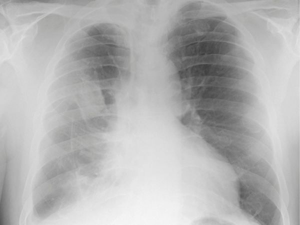 Les plaques pleurales